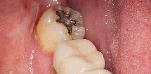 Calzada dental Calzada dental