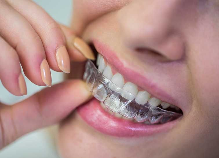 Una férula para dientes<br />
