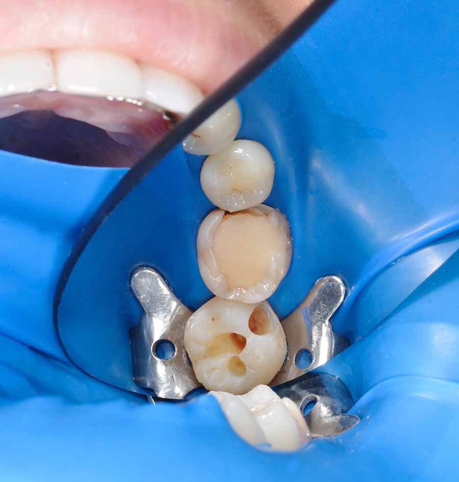 Resina en muela Resina en muela