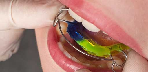 ortodoncia placa inferior