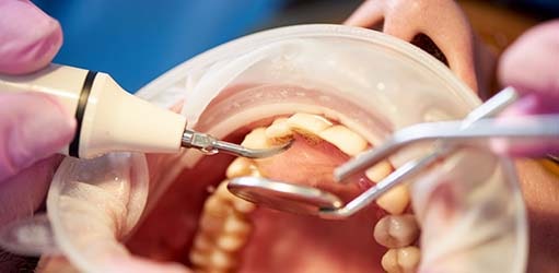 Limpieza dental periodoncia