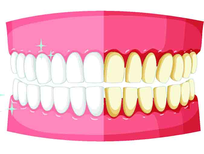 Periodoncia en dientes