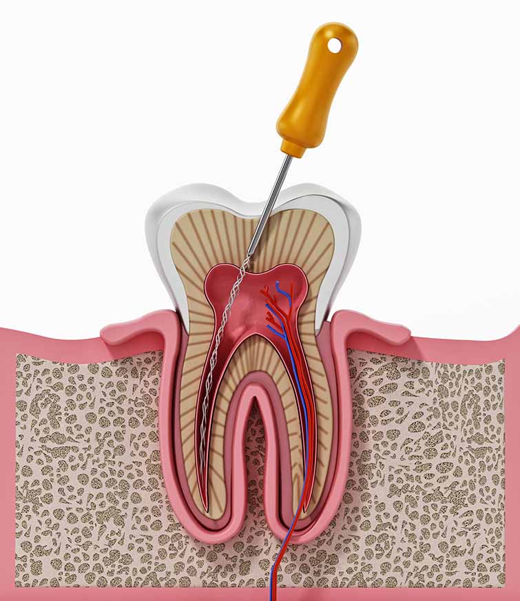 conducto radicular conducto radicular