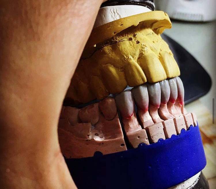 Muestra de implante dental